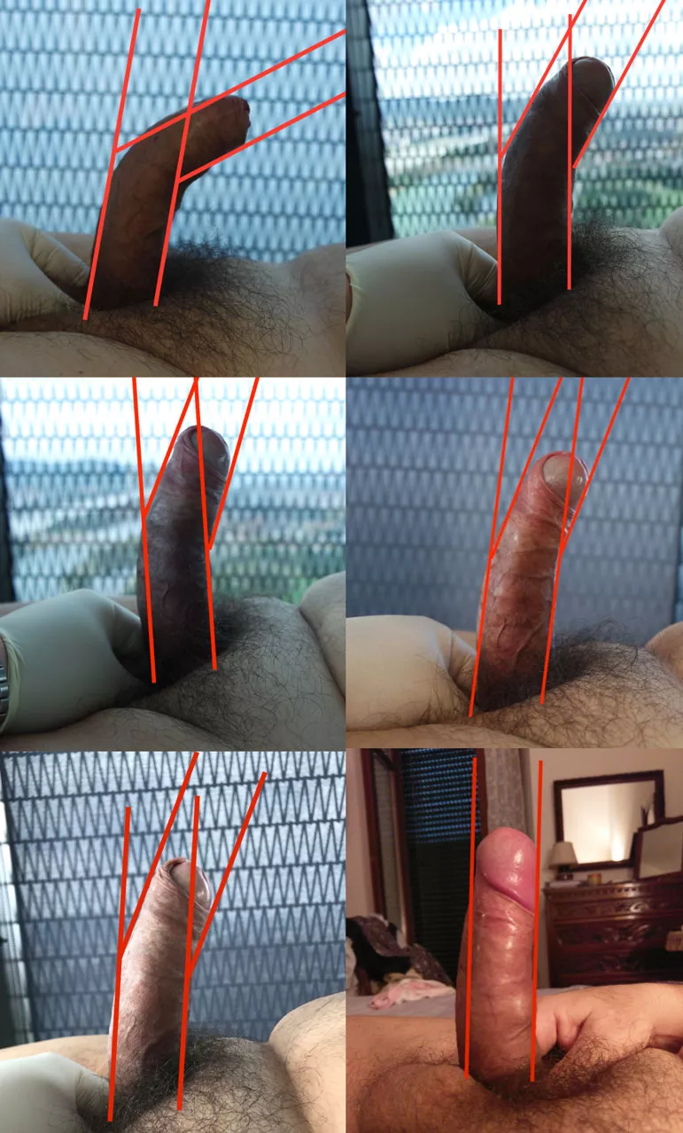 Penile Discoloration