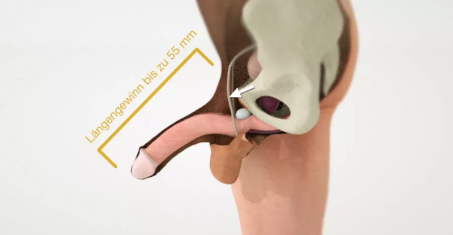 Penisverlngerung: Grerer Penis durch Ligamentolyse OP | Dr Kuehhas