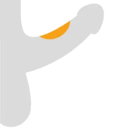 Leichte Verkrümmung