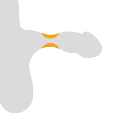 Sanduhr-Phänomen bei IPP
