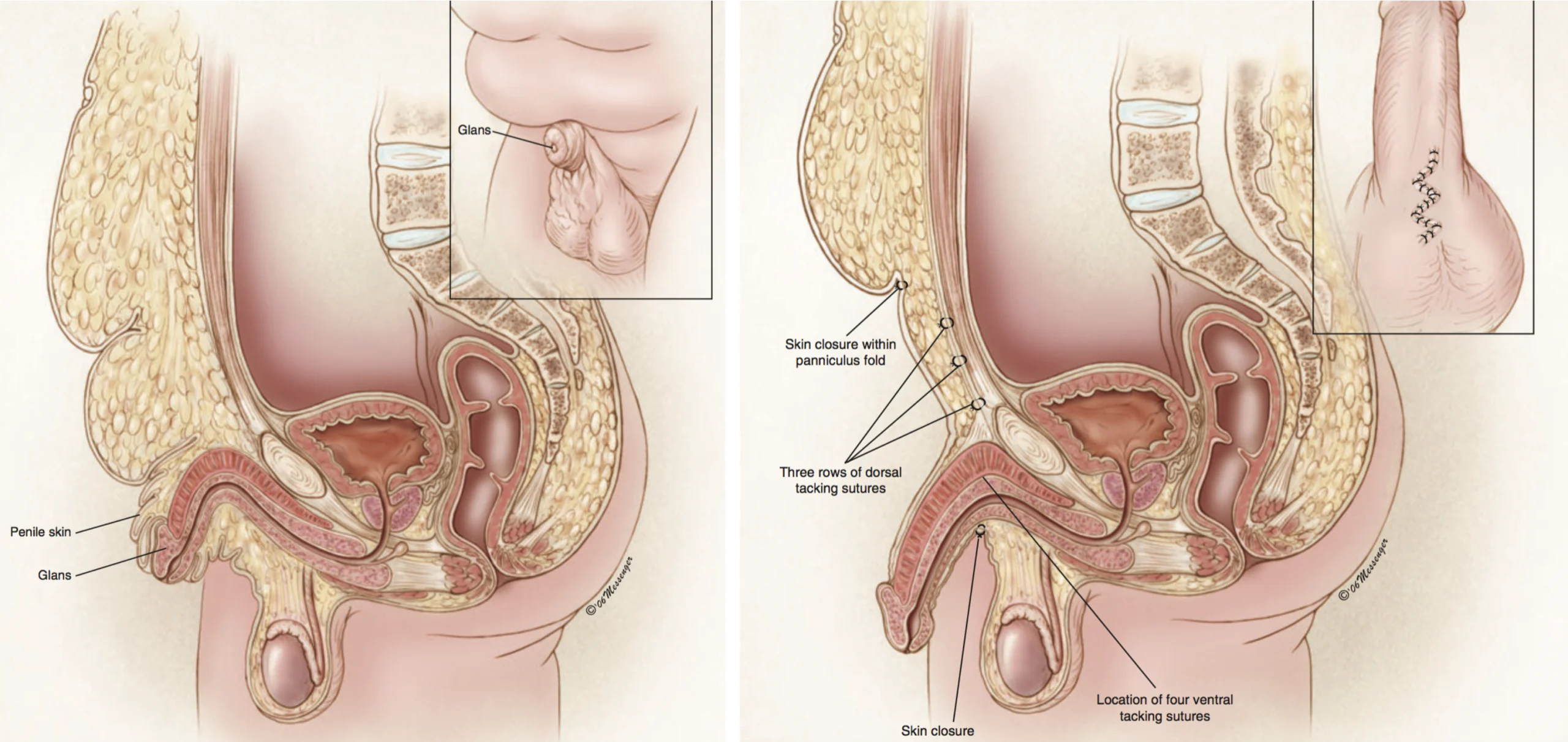 Anatomische Darstellung eines vergrabenen Penis vor und nach operativer Freilegung des Penisschafts durch Reduktion von Fett- und Weichteilgewebe im Bereich des Schamhügels.